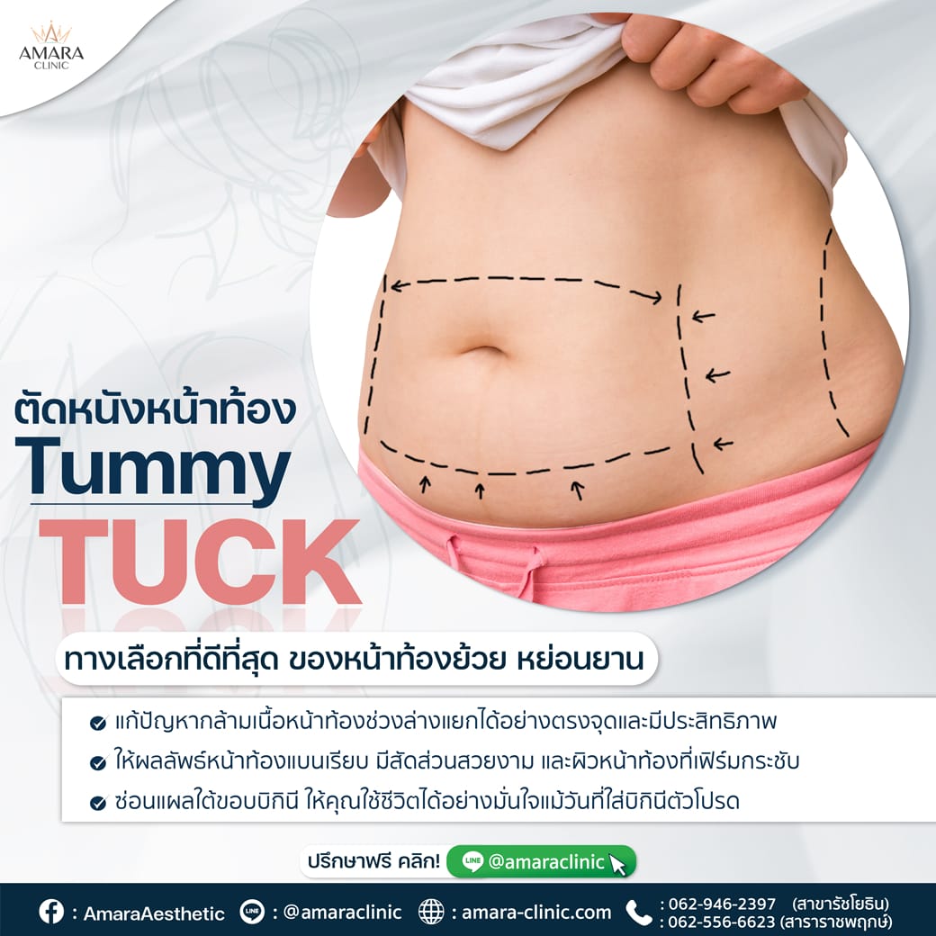 20221117-Aware-single-Tummy Tuck-01